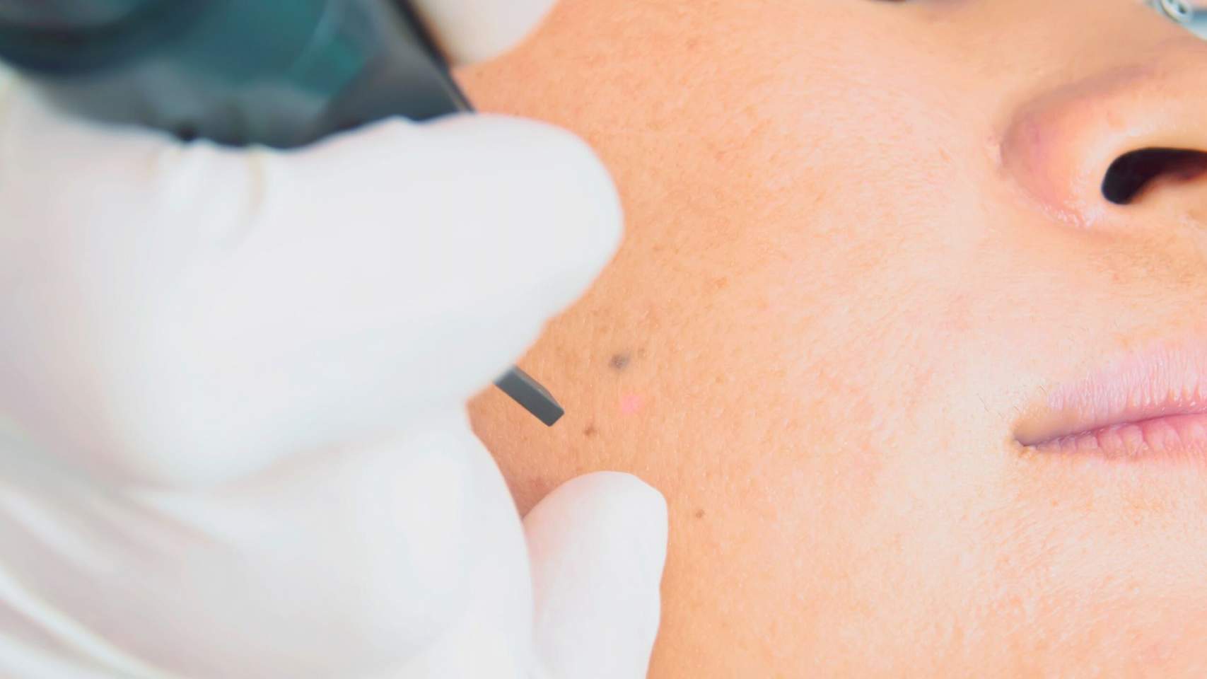 Tractament l&agrave;ser / Foto:CNV